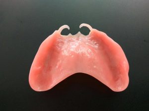 Prothèse valplast imprimée